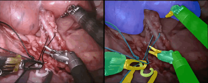 Q-VISION Surgical AI Visualization